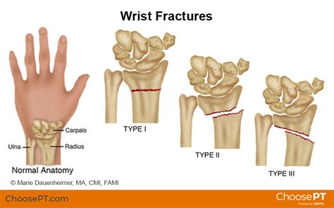 Guide Physical Therapy Guide To Wrist Fracture Choose Pt