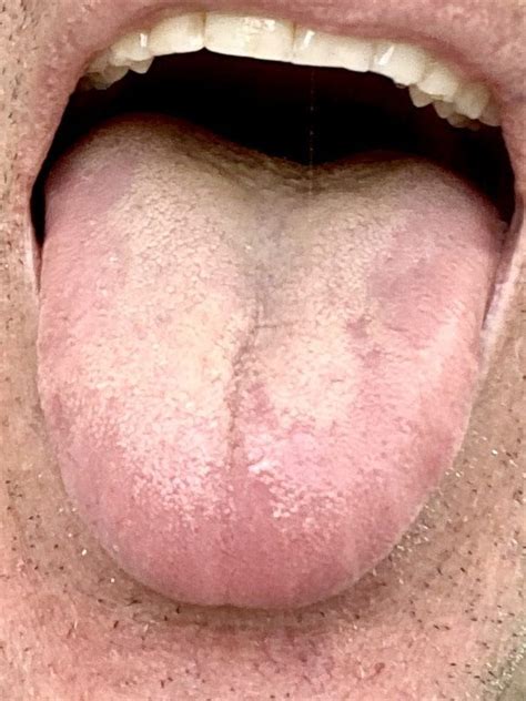 Acupuncture Boca Raton Why Does My Acupuncturist Ask To Look At My Tongue Dr Tony Willcox D