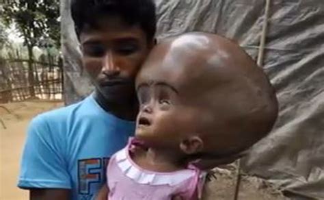 Girl With Swollen Head Offered Help Thanks To Media Video
