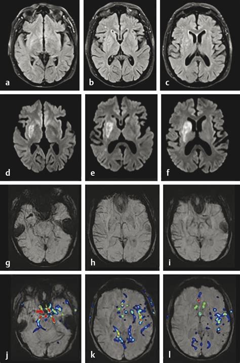 4 Imaging Techniques In Acute Ischemic Stroke Neupsy Key