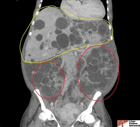 Pathology Pearls Autosomal Dominant Polycystic Kidney Disease