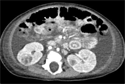 Intralobar Nephrogenic Rests In A 4 Month Old Girl With A History Of