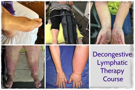 Lymphoedema Training Course Decongestive Lymphatic Therapy