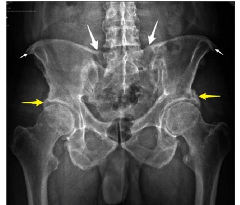Anteroposterior Ap Radiograph Of The Pelvis Shows Calcification Of