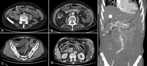 Contrast Enhanced Abdominal Computed Tomography Ct Imaging Axial