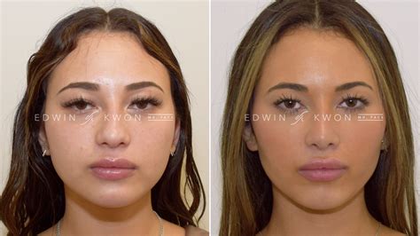Buccal Fat Removal Before And Afters Edwin Kwon Md Facs
