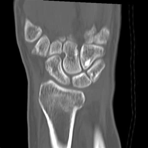 Colles Fracture Image