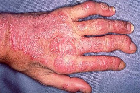 Psoriatic Arthritis Primary Care Dermatology Society Uk