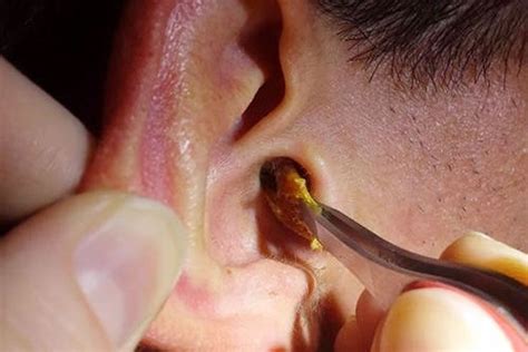 Clogged Ears And How To Unclog It