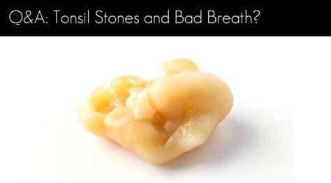 I Have Tonsil Stones And Bad Breath Windsor Dentists