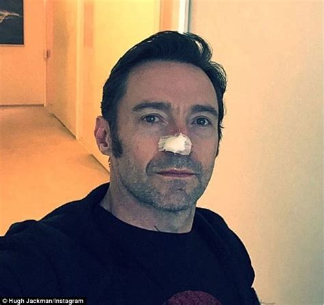 Hugh Jackman Has A 6th Skin Cancer Cut Out From His Nose Daily Mail Online