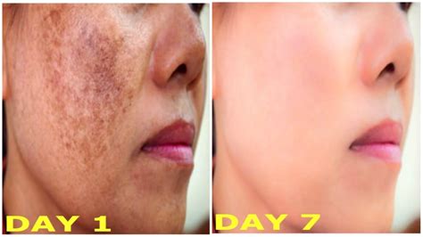 How To Remove Pigmentation Blemishes Dark Spots From Face