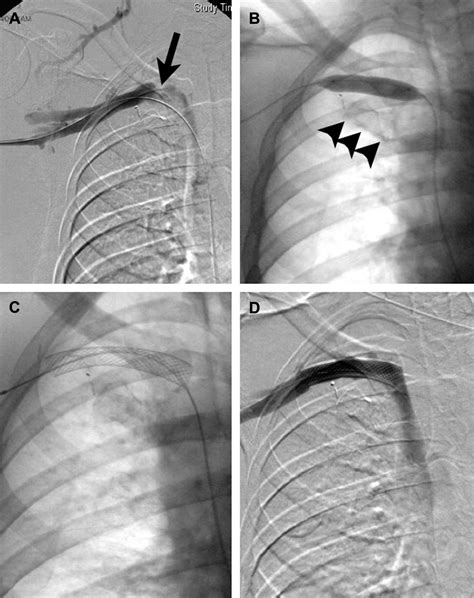 Subclavian Vein Stent Fracture And Venous Motion Annals Of Vascular