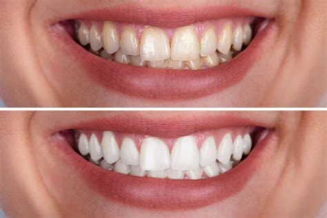 Teeth Whitening Vs Teeth Cleaning Hamilton Dental Centre
