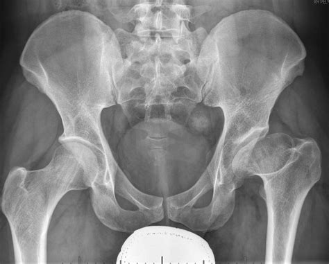 Adult Dysplasia Of The Hip Recon Orthobullets