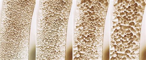 Osteoporoza Przyczyny Objawy Badania Leczenie Rehabilitacja