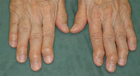 Osteoarthritis Hand Wikinus