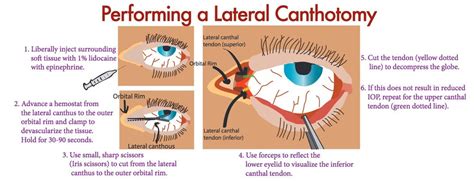 Lateral Canthotomy Antrim Ed Meducation