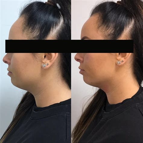 Does Cavitation Work For Double Chin
