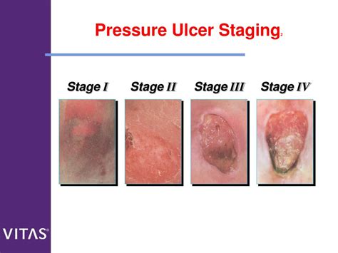 Stage 3 Pressure Ulcer Turning Schedule