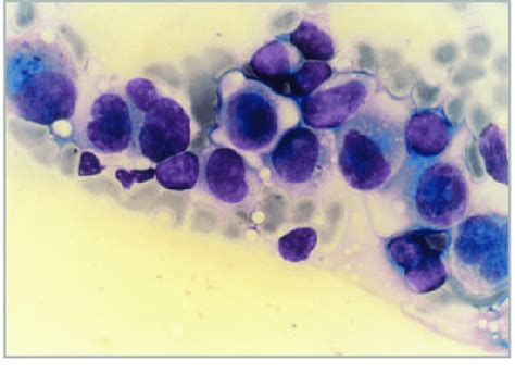 Fine Needle Aspiration Cytology Of A Melanoma Metastasis Download