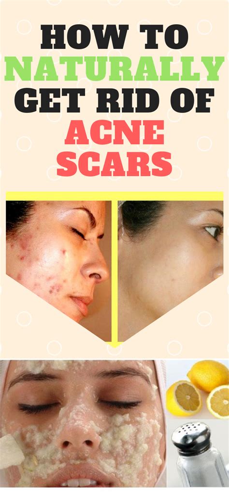 Run Healthy Lifestyle How To Naturally Get Rid Of Acne Scars