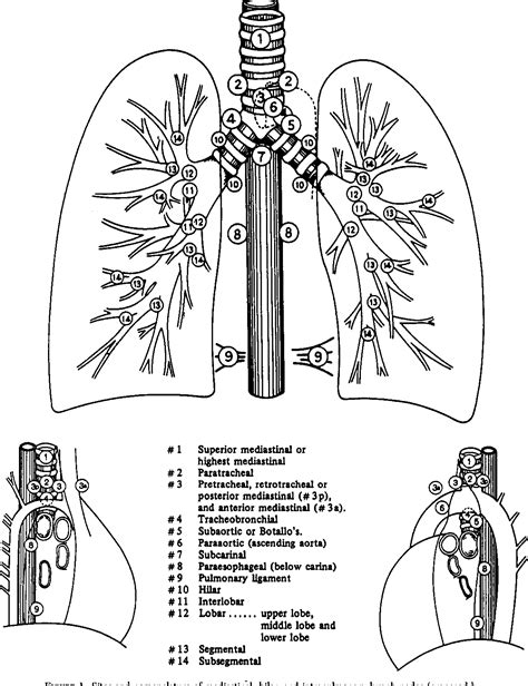 Figure 1 From Mediastinal Spread Of Metastatic Lymph Nodes In