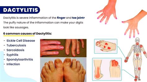 Dactylitis Sausage Fingers Digit Swelling Of Fingers And Toes