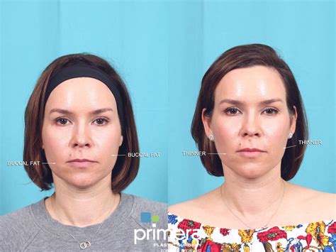 Buccal Fat Cheek Fat Removal In Orlando Florida