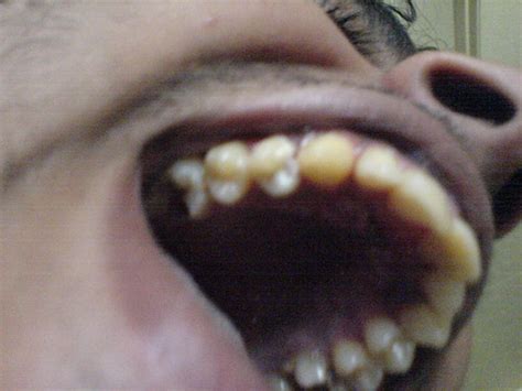 Teeth So Messed Up He Needs A New Set Naser Risk Flickr