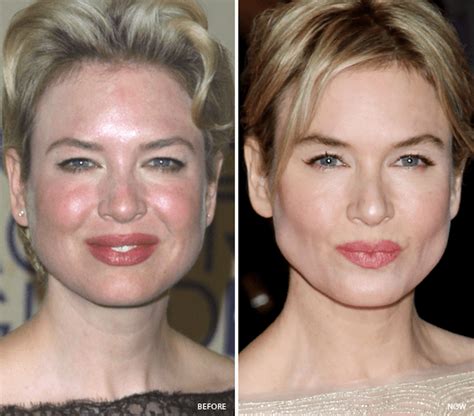20 Celebrities With Worst Skins Lively Pals Hyperpigmentation Hair