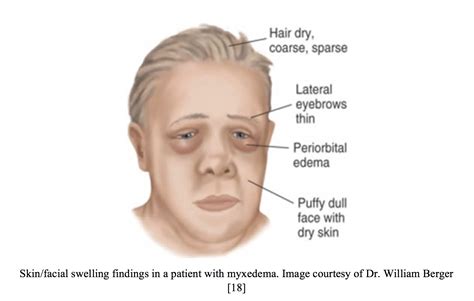 Prednisone Swelling Face Facial Swelling Caused By Prednisone