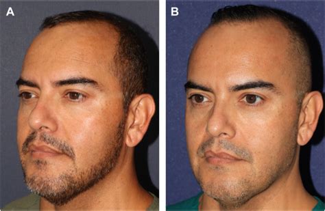Nonsurgical Facial Rejuvenation In Males Advances In Cosmetic Surgery