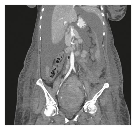 A B Coronal Views Of Ct Abdomen And Pelvis With Contrast Show A