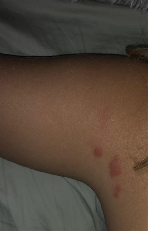Do Bed Bug Bites Leave Dark Spots Bedbugs