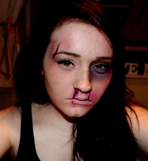 Frequent bloody noses are a nuisance and may be serious. Black Eye, Spilt Lip, Spilt Eyebrow and Bloody Nose | Flickr