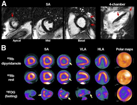 Advanced Imaging Of Cardiac Sarcoidosis Journal Of Nuclear Medicine