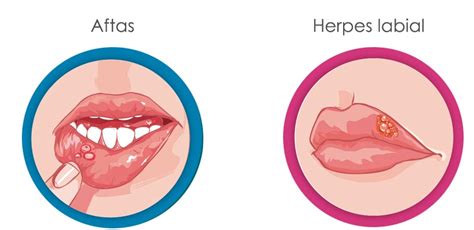 Diferencias Entre Herpes Labial Y Aftas Bucales Sooluciona My XXX Hot