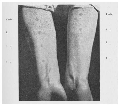 Figure 22 ‘photograph Showing Erythema Produced By Graduated Exposure