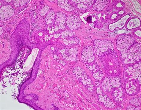Dermoid Cyst Mature Cystic Teratoma Ovary Bosnianpathology