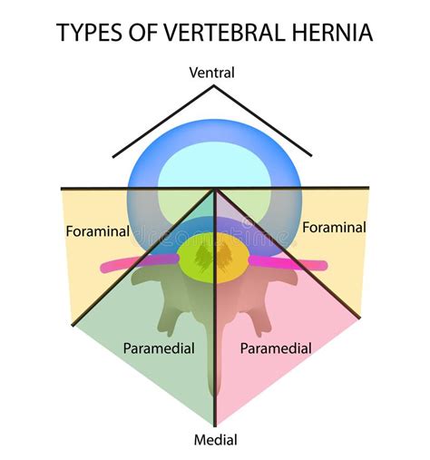 Types Of Hernia Epigastric Lateral Umbilical Inguinal Femoral