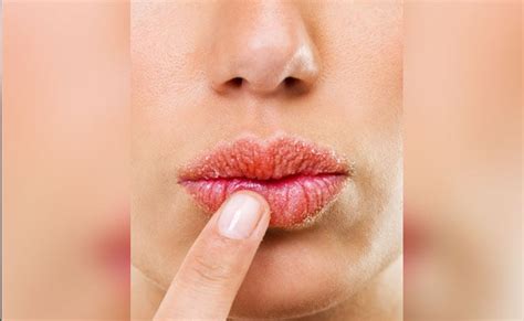 Chapped Lips In Winter Expert Lists Reasons And Solution