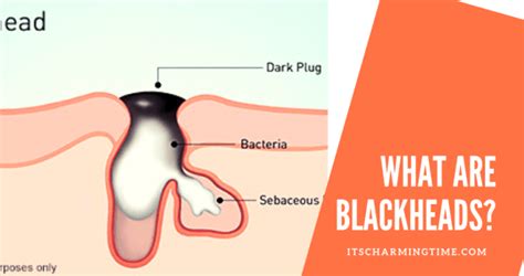 Get Rid Of Blackheads Important Facts Natural Cure And Home Remedies