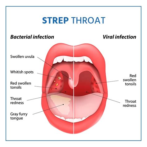 Strep Throat Symptoms Causes And Treatment