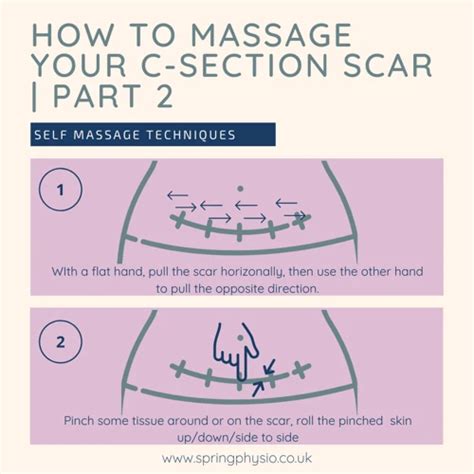 How To Massage C Section Scar A Guide To Help You Reduce Scar Tissue And Improve Recovery