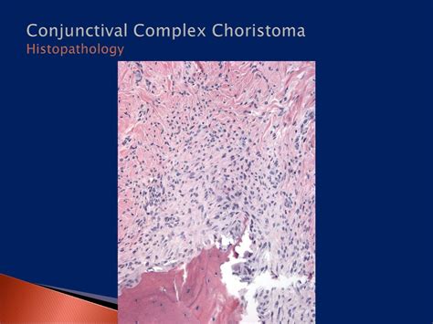 Conjunctival Complex Choristoma Ppt Download