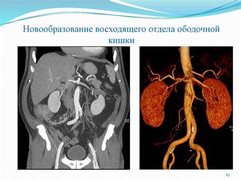 Диеты при опухоли толстой кишки