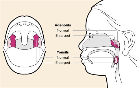 Tonsil Diagram Anatomy