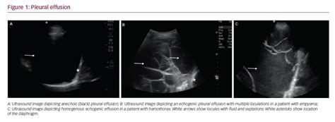 The lack of specificity is mainly due to the limitations of the imaging modality. Practice Pearls for Performing Pleural Ultrasound with ...