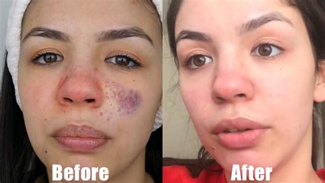 How To Get Rid Of Redness Around Nose Health For Best Life